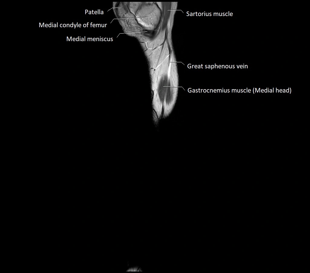 Lower leg sagittal anatomy 3T MRI image 28.webp